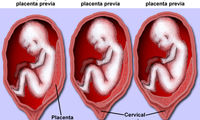 جفت پایین یا پلاسنتا پریویا