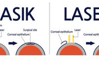 لازک یا لیزیک، کدام بهتر است؟