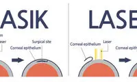 لازک یا لیزیک، کدام بهتر است؟