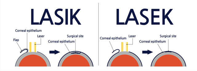 لازک یا لیزیک، کدام بهتر است؟