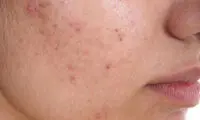 رابطه تستوسترون و آکنه چیست؟
