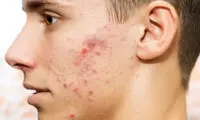 رابطه باورنکردنی پوسیدگی دندان و جوش صورت