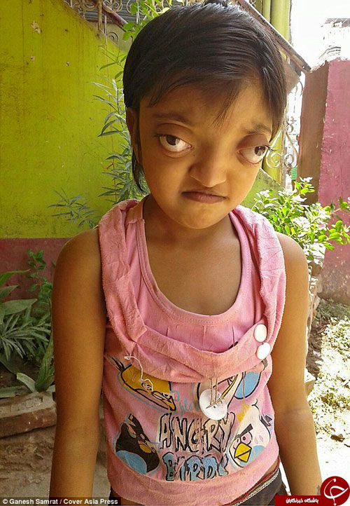 بیماری نادر یک دختر بچه +عکس