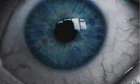 تشخیص آلزایمر از روی چشم