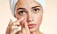 ترفند‌های آرایشی برای پوشاندن جوش صورت