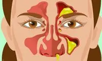 نکاتی که ترشحات بینی درباره سلامتی می‌گویند‌