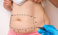 لیفت شکم و پهلو با روش جراحی و بدون جراحی + هزینه