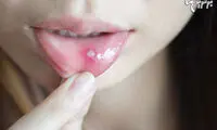 چه زمانی آفت دهان خطرناک می‌شود؟