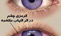 علت قرمزی چشم و خطرات ناشی از آن
