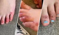 انگشت پای کوویدی؛ عجیب‌ترین علامت ویروس کرونا