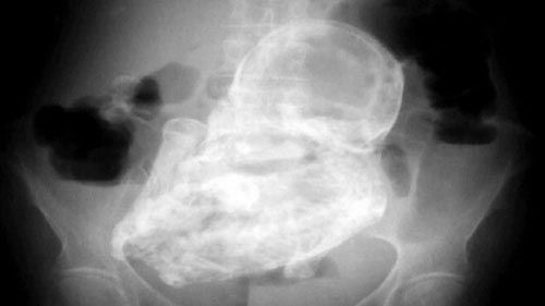 جنین سنگی 40 ساله در شکم پیرزن! +عکس