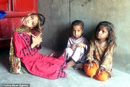 «کج گردنی»، اختلال عجیب دختر پاکستانی