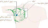 توده زیر بغل همان سرطان است؟!