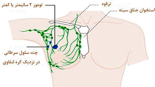 توده زیر بغل همان سرطان است؟!