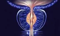 چگونه احتمال ابتلا به سرطان پروستات را کم کنیم؟
