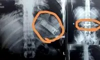 نجات یک بیمار از خطر انفجار معده!