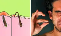 مو‌های زیر پوستی چرا به وجود می‌آیند؟