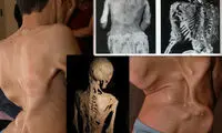 بیماری‌های عجیبی که نامشان را هم نشنیده اید