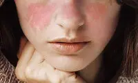 با این رژیم غذایی بیماری لوپوس را ضربه فنی کنید