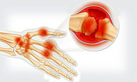 کاهش ورم مفاصل روماتیسم با فناوری نانو
