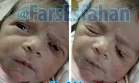 پارگی پلک نوزاد نطنزی، قصور پزشکی بود؟