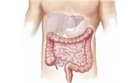 فاکتورهای مهم در ابتلای زودهنگام به سرطان روده