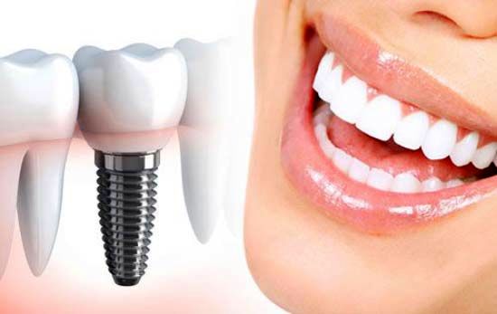 ویژگی‌های ایمپلنت دندان خوب و باکیفیت