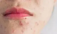 رایج‌ترین مشکلات پوستی و نحوه درمان آن‌ها