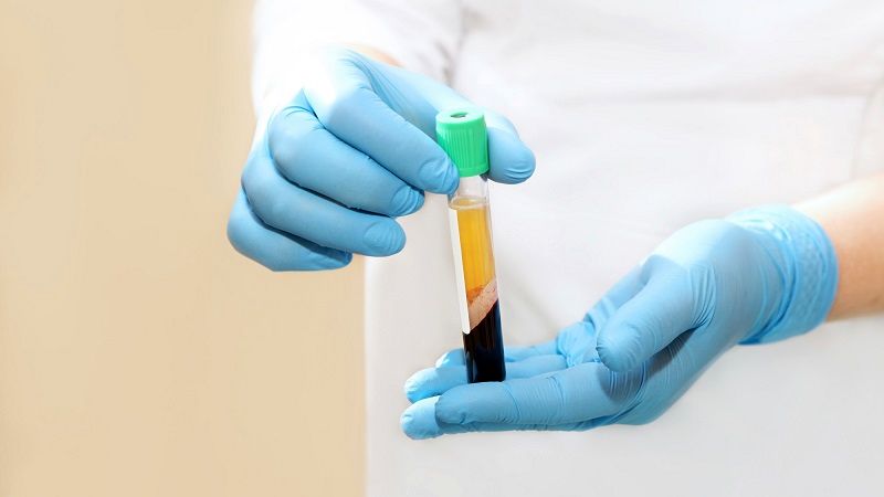 مقایسه PRP با درمان‎های دارویی دیگر؛ کدام روش بهتر است؟