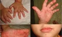 درباره شیوع یک بیماری به اسم «دست،‌ پا و دهان»