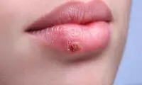 چرا تبخال می‌زنیم؟