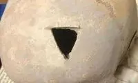 کشف جمجمه سوراخ شده انسان با قدمت ۳۲۰۰سال