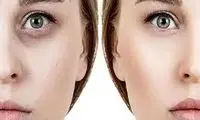 بهترین دکتر برای تزریق فیلر زیر چشم کیست؟