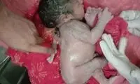 تصاویری تعجب‌برانگیز از تولد نوزاد پسر با سه دست!
