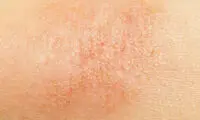 با خشکی پوست نوزاد در زمستان چه کنیم؟