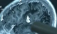 کِرمی پس از ۱۷سال از مغز بیمار چینی خارج شد