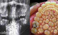 تصاویر باورنکردنی از پسری با 264 دندان