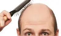 ۵۰درصد ایرانی‌ها مشکل ریزش موی سر دارند!