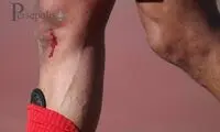 شهریار مغانلو مصدوم شد