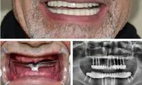 بهترین ایمپلنت دندان؛ ایمپلنت کره‌ای یا ایمپلنت سوئیسی؟