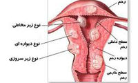 فیبروم رحم؛ نبرد زنانه با توده های معمولی