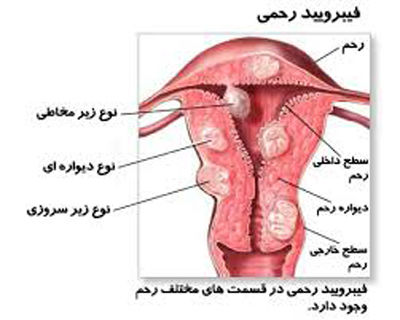 فیبروم رحم؛ نبرد زنانه با توده های معمولی