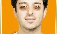 راه های کم‌رنگ‌کردن سیاهی‌های زیر چشم