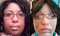 رشد ناخن به جای مو روی پوست +عکس