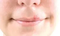 چند درمان خانگی برای خداحافظی با تبخال