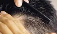 ابداع درمان های ریزش مو با سلول های بنیادی