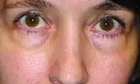 راه های از بین بردن پُف زیر چشم