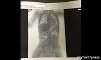 حلقه ازدواج پدر و مادر در شکم نوزاد!