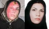 یک زن دیگر قربانی اسیدپاشی شد/عکس 18+