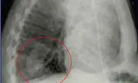 عجیب ترین اشیا پیدا شده در بدن انسان